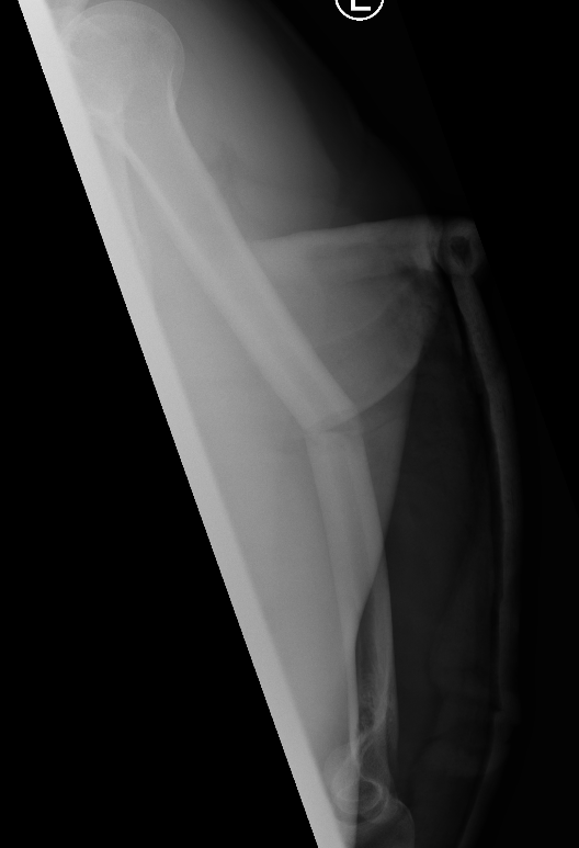 Humerus shaft 2